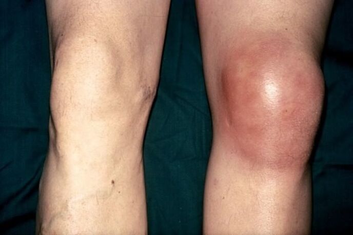 healthy and swollen knee from pain