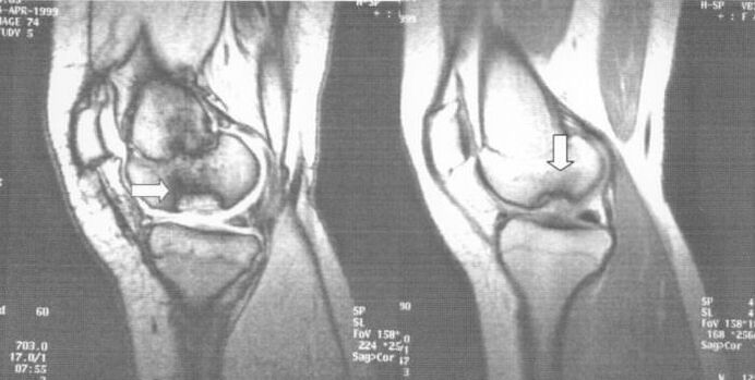 radiograph of osteochondrosis dissecans in the knee joint